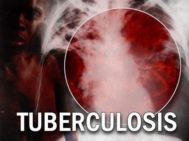 http://nursingisbeautiful.files.wordpress.com/2010/10/tuberculosis.jpg